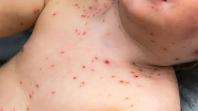  Risks or complications with chickenpox vaccination