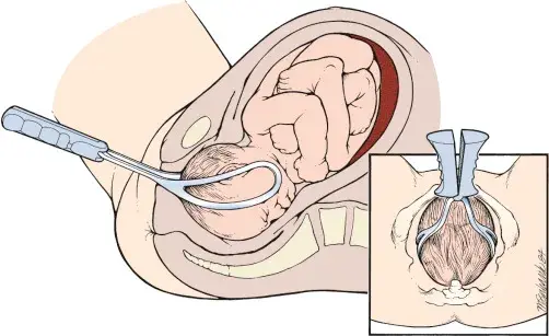 An illustration demonstrating the proper application of obstetric forceps on a baby’s head during a assisted vaginal birth