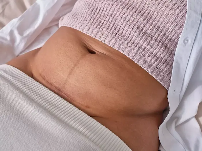 C-Section Recovery Timeline and Essential Tips