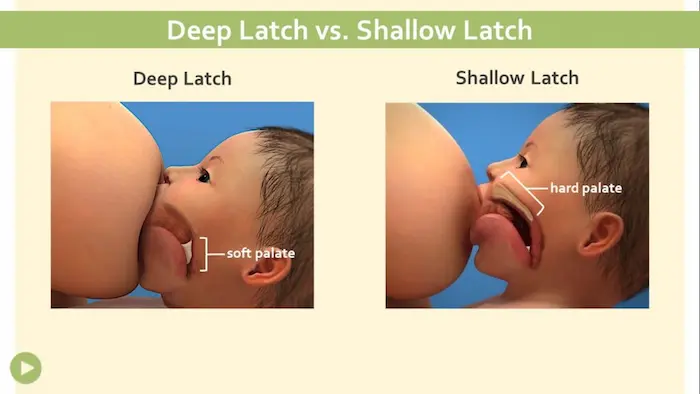 Comparison of deep, asymmetrical latch with baby's mouth covering areola versus shallow latch with nipple only