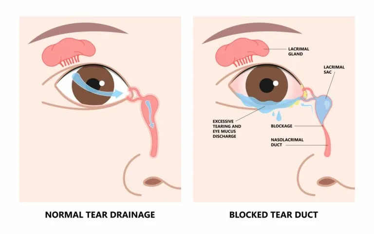 Diagram of an infant's tear duct system showing a potential blockage