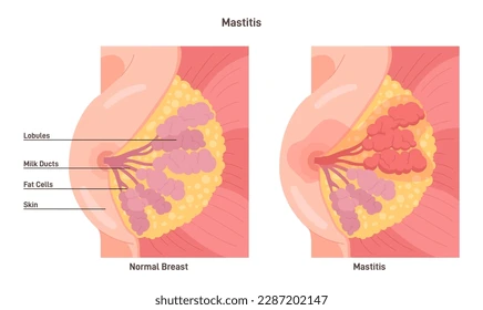 Diagram of breast showing characteristic red, inflamed area of mastitis