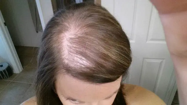 Hair Loss After Pregnancy