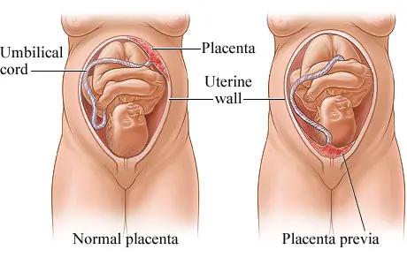 Placenta Previa: Causes, Symptoms, and Treatment