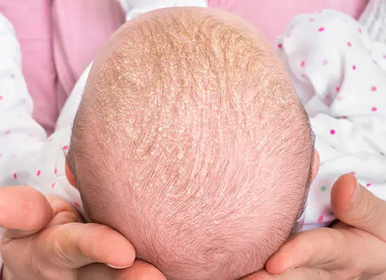 Preventing and Treating Cradle Cap