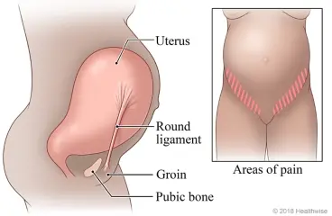 Round Ligament Pain