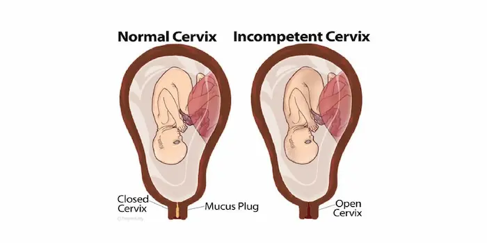 Understanding Cervical Insufficiency
