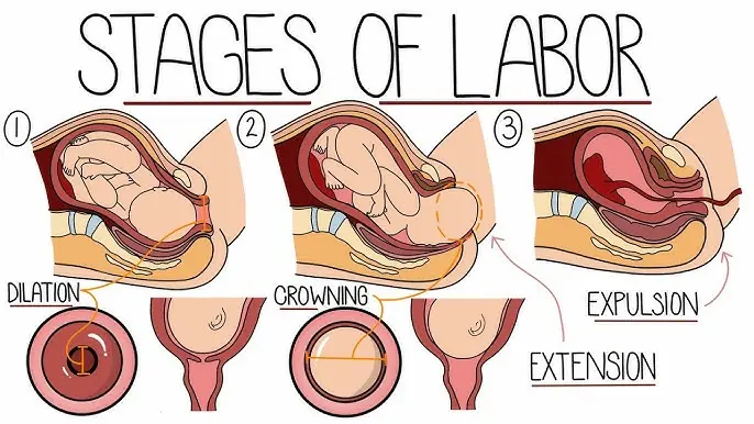 Understanding the Stages of Labor