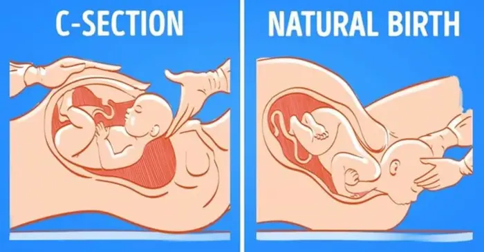 Vaginal Birth After Cesarean Is It Right for You