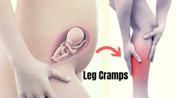What Causes Leg Cramps in Pregnancy
