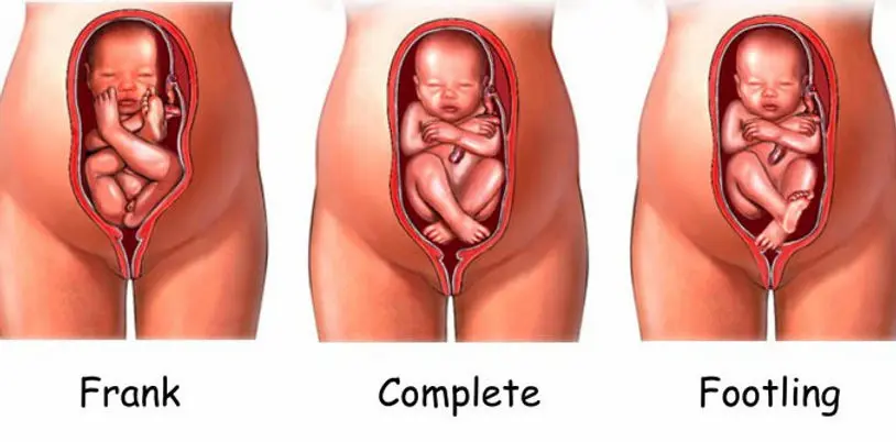 What Does It Mean if Your Baby Is Breech